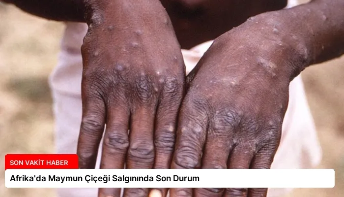 Afrika’da Maymun Çiçeği Salgınında Son Durum